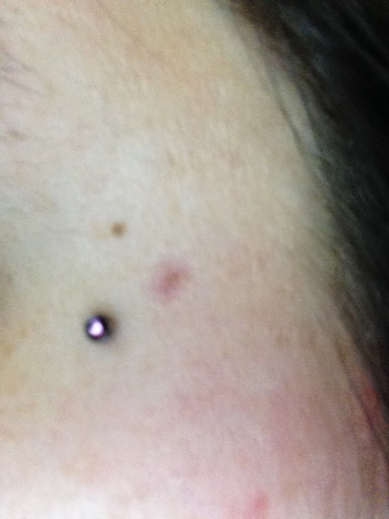 }039{ Dermal Rejection » Renew Life Start